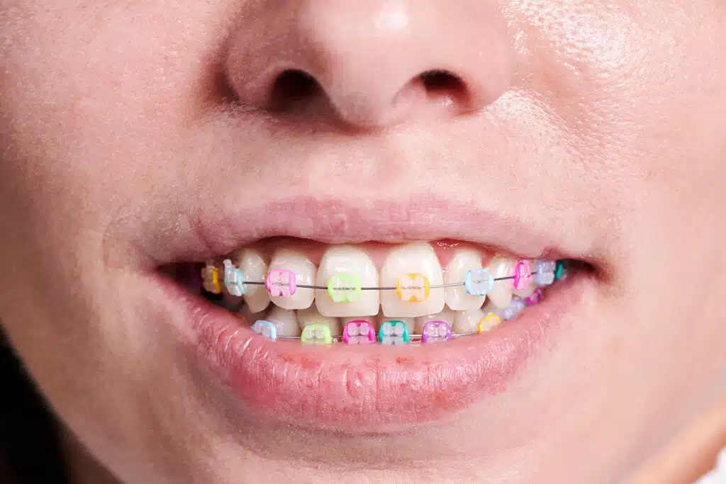 Appareil dentaire enfant avant 7 ans
