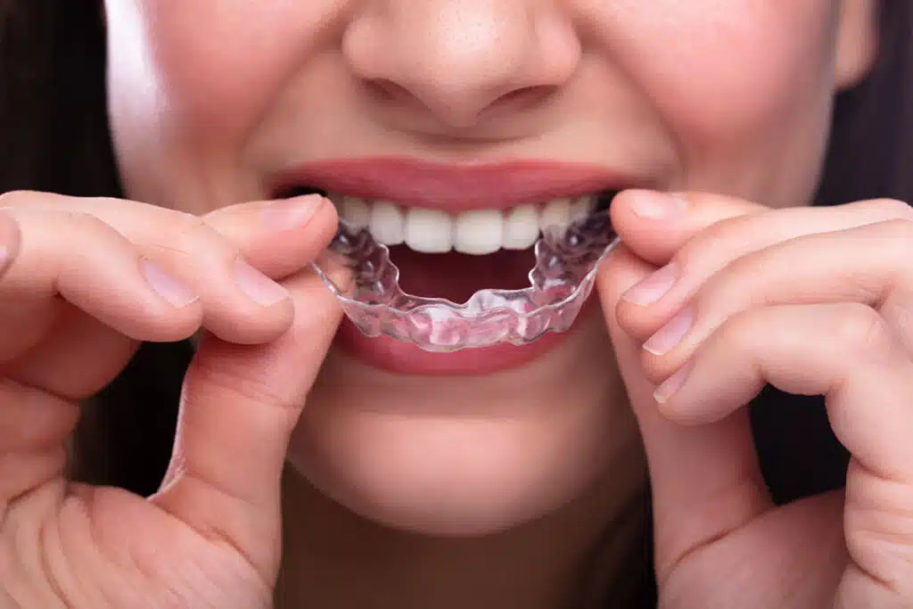 Traitement de l'orthodontie